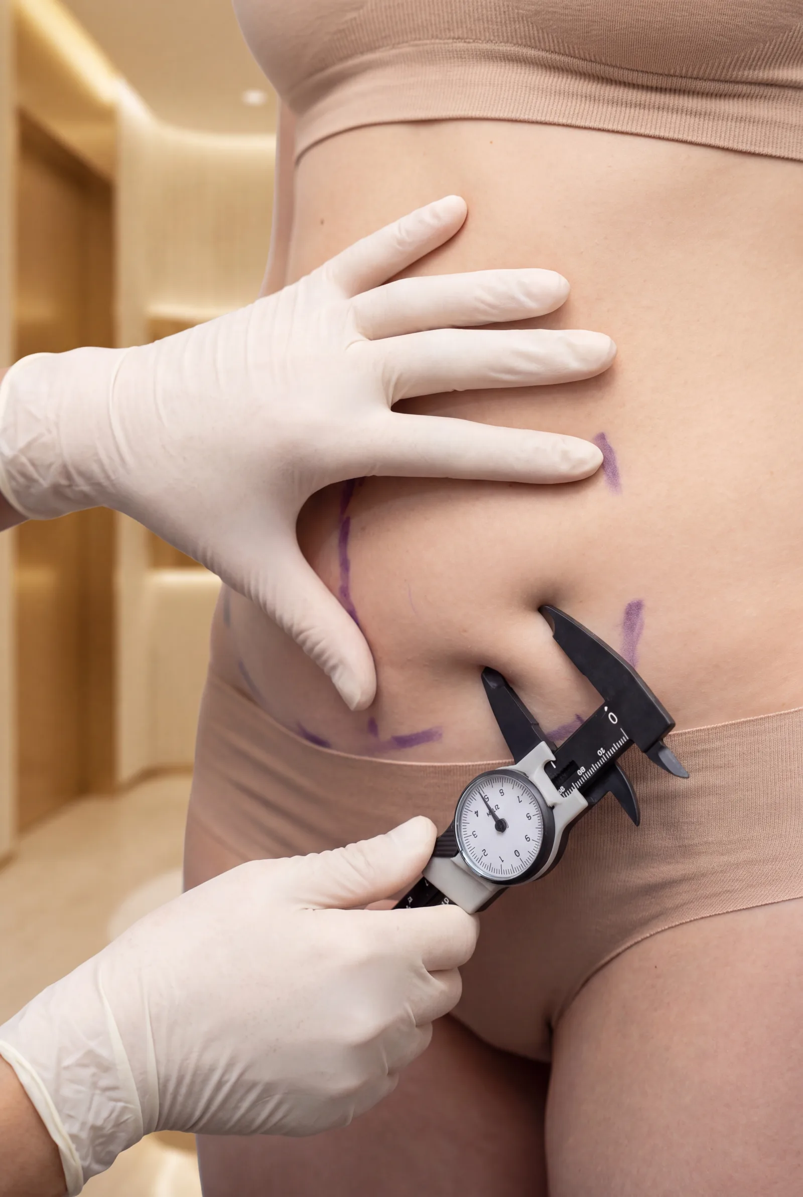 تحديد ما قبل الجراحة وتخطيط عملية شد البطن في Elora Polyclinic