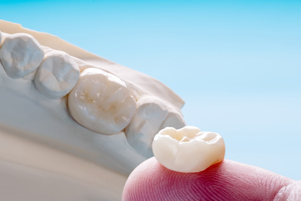 Dental Crown in Dubai