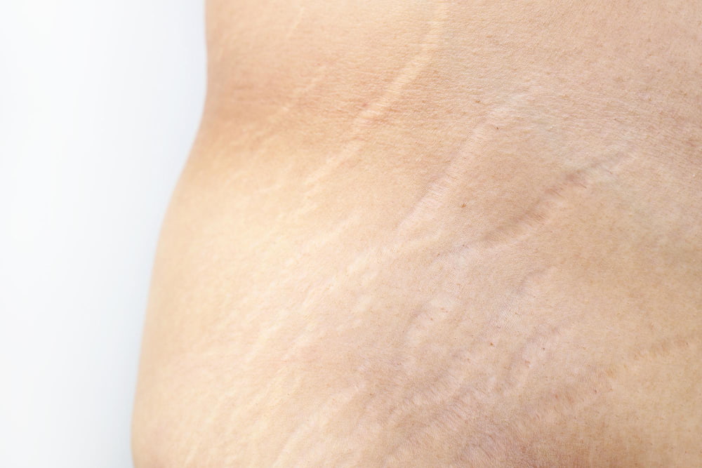 stretch marks removal