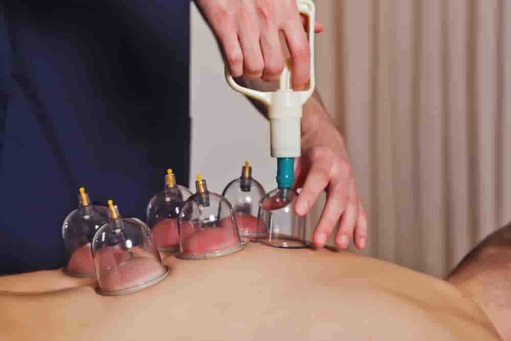cupping massage