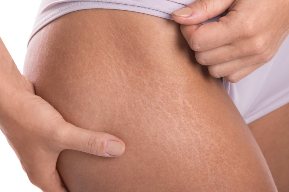 stretch marks removal