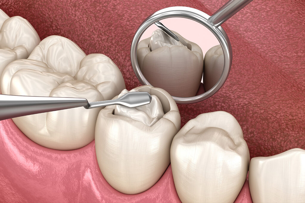 Composite dental filling