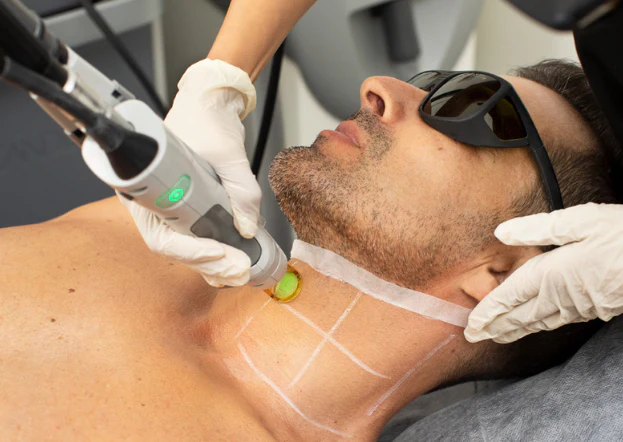 male laser hair removal