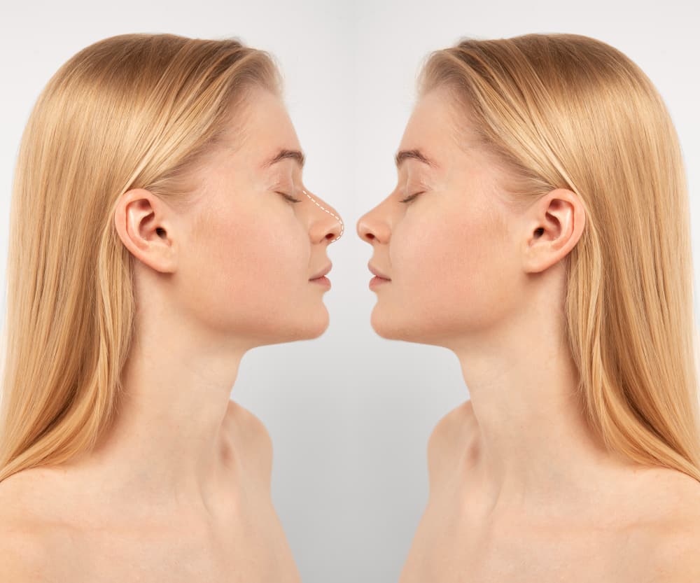 Rhinoplasty surgery in Dubai