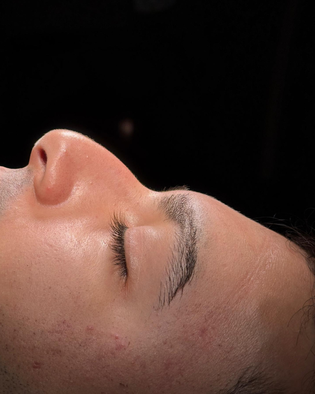 Scarless Rhinoplasty in Dubai