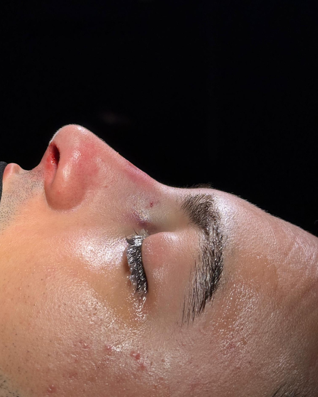Scarless Rhinoplasty in Dubai