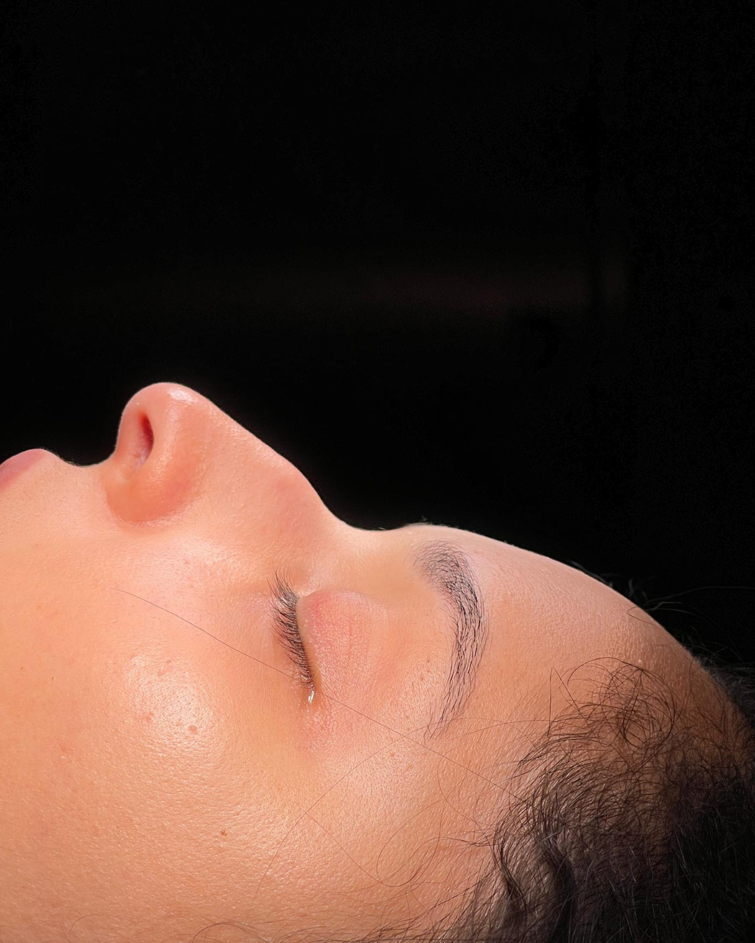 Scarless Rhinoplasty in Dubai