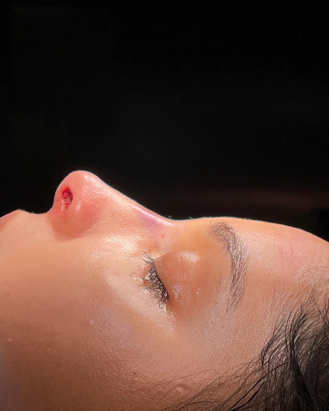 Scarless Rhinoplasty in Dubai