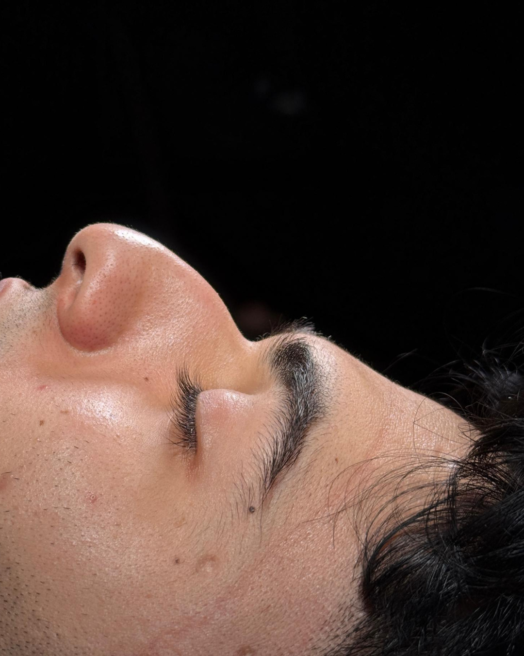 Scarless Rhinoplasty in Dubai