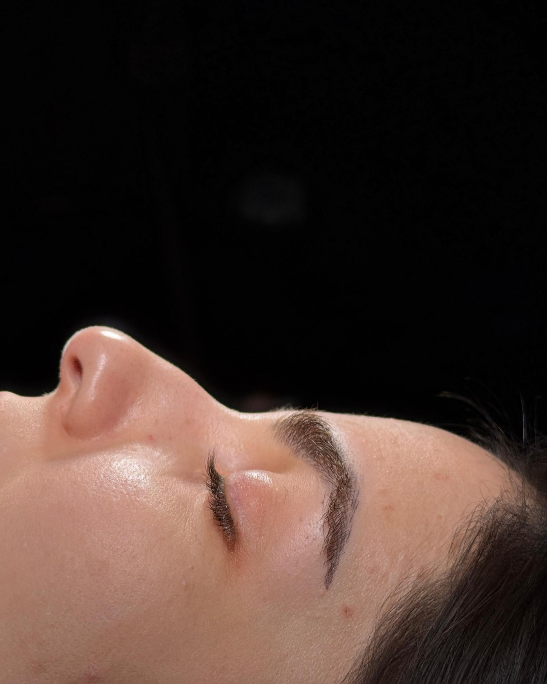 Scarless Rhinoplasty in Dubai