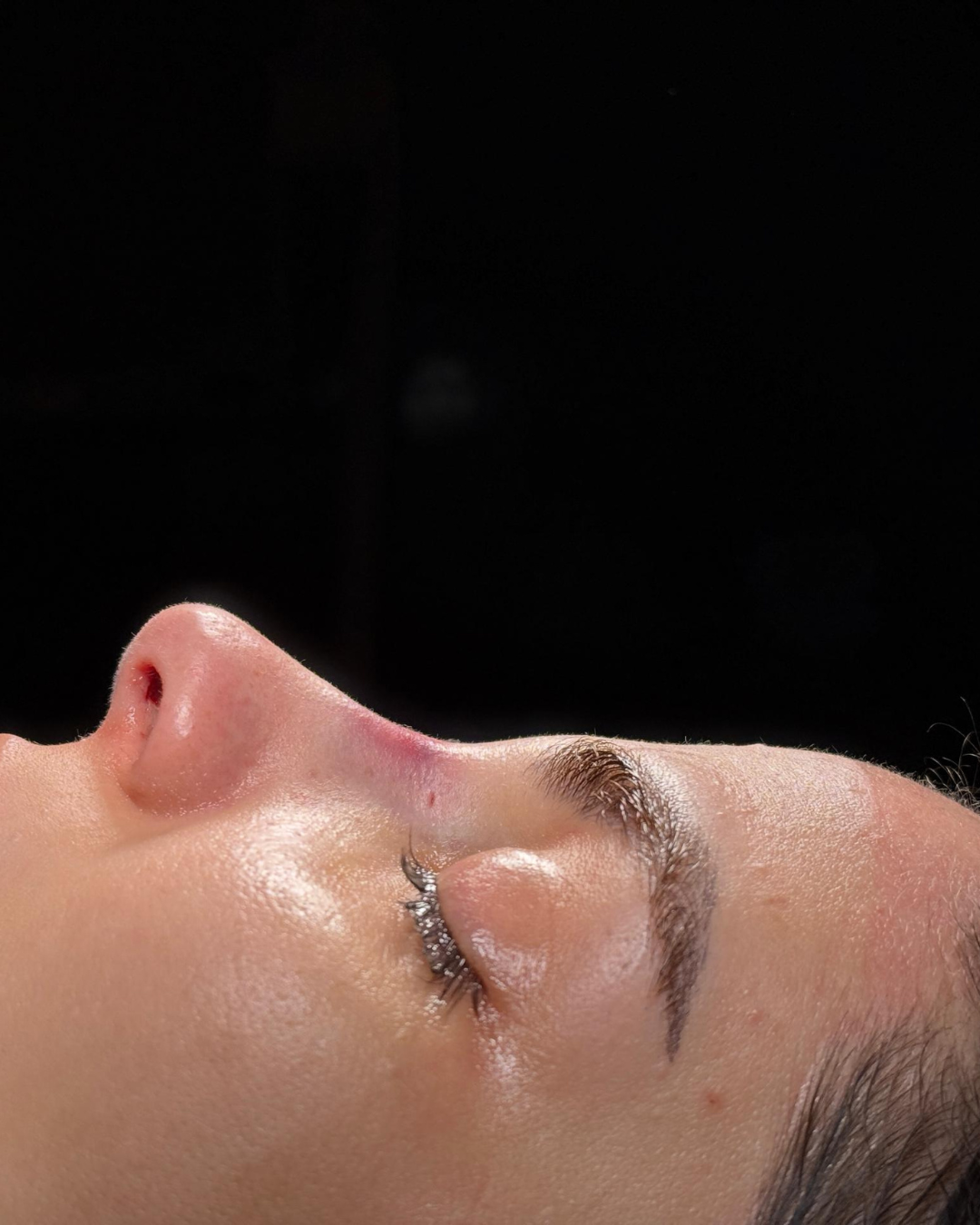 Scarless Rhinoplasty in Dubai