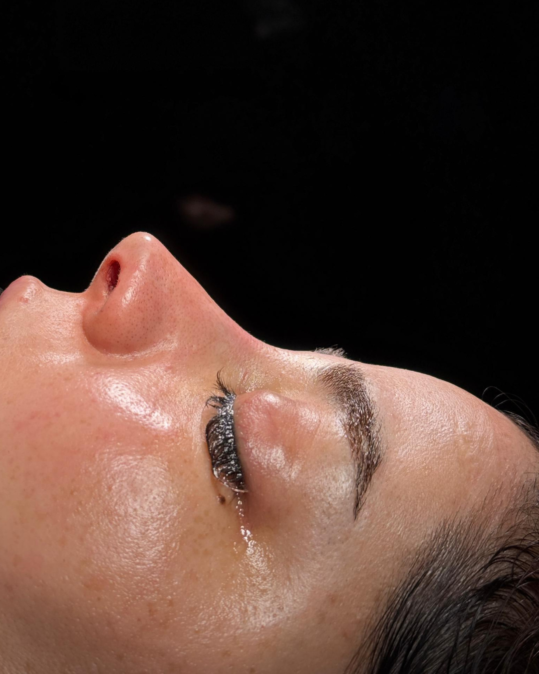 Scarless Rhinoplasty in Dubai