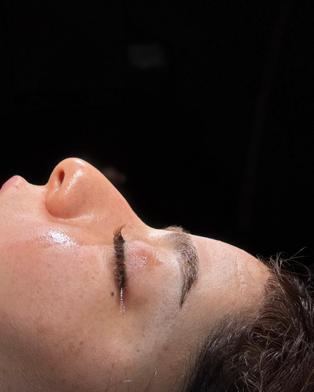 Scarless Rhinoplasty in Dubai