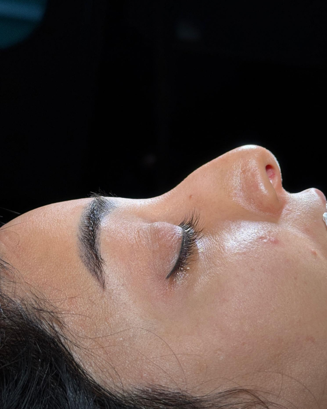 Scarless Rhinoplasty